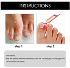 Ingrown Toenail Drops 60 ml Pack of 2